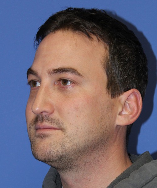 Blepharoplasty 2735 – Click HERE for more views after photo. Individual results may vary.