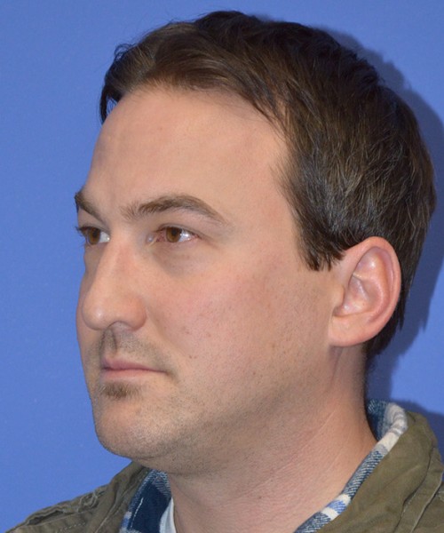 Blepharoplasty 2735 – Click HERE for more views before photo. Individual results may vary.