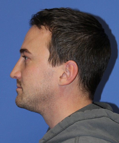 Blepharoplasty 2735 – Click HERE for more views after photo. Individual results may vary.