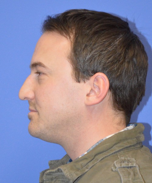 Blepharoplasty 2735 – Click HERE for more views before photo. Individual results may vary.