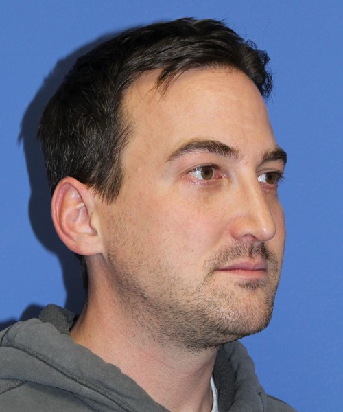 Blepharoplasty 2735 – Click HERE for more views after photo. Individual results may vary.