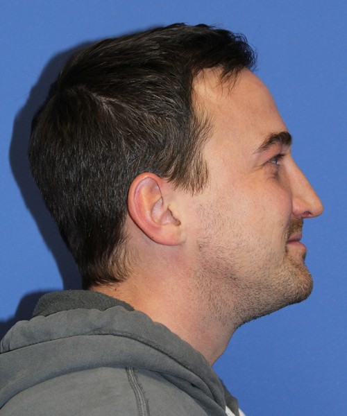 Blepharoplasty 2735 – Click HERE for more views after photo. Individual results may vary.