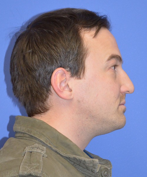 Blepharoplasty 2735 – Click HERE for more views before photo. Individual results may vary.