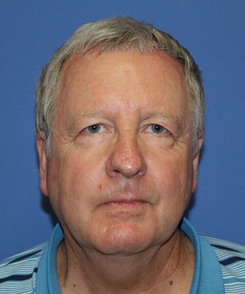 Blepharoplasty 2746 – Click HERE for more views before photo. Individual results may vary.