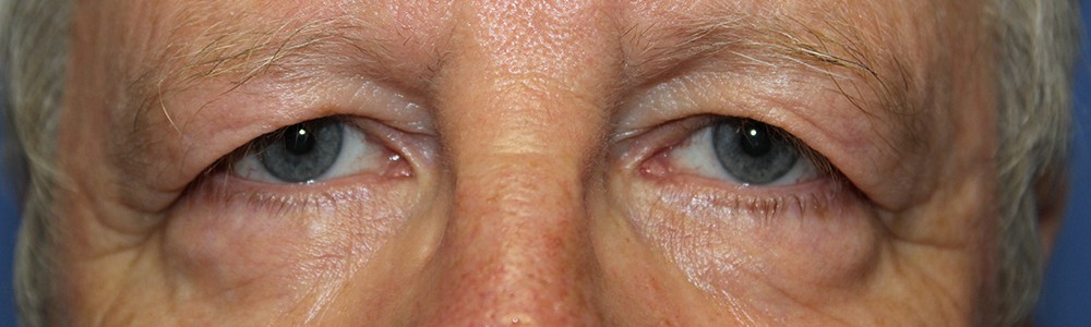 Blepharoplasty 2746 – Click HERE for more views before photo. Individual results may vary.