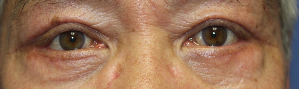 Blepharoplasty 2768 – Click HERE for more views after photo. Individual results may vary.