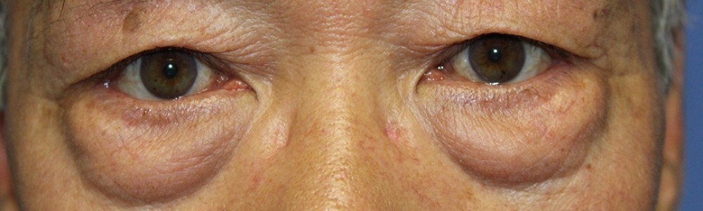 Blepharoplasty 2768 – Click HERE for more views before photo. Individual results may vary.