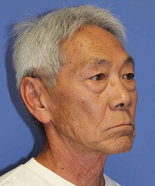 Blepharoplasty 2768 – Click HERE for more views before photo. Individual results may vary.