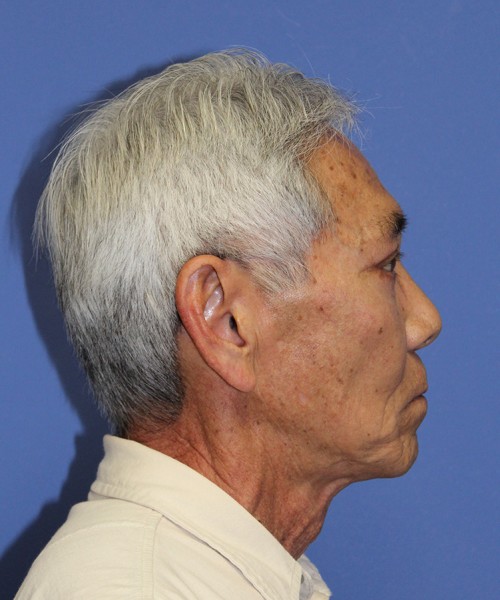 Blepharoplasty 2768 – Click HERE for more views after photo. Individual results may vary.