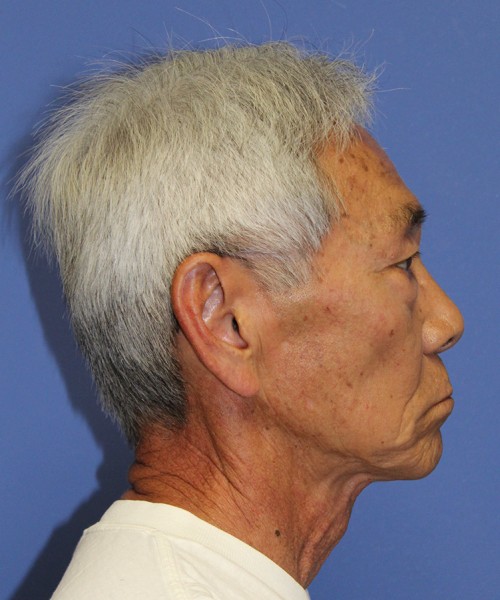 Blepharoplasty 2768 – Click HERE for more views before photo. Individual results may vary.