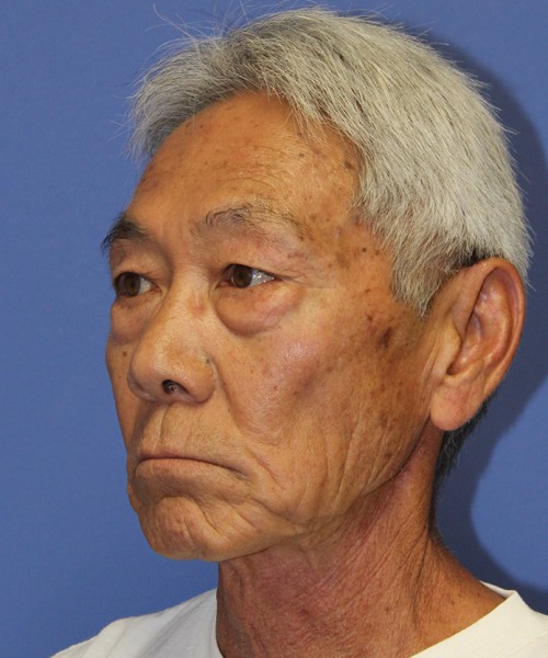 Blepharoplasty 2768 – Click HERE for more views before photo. Individual results may vary.