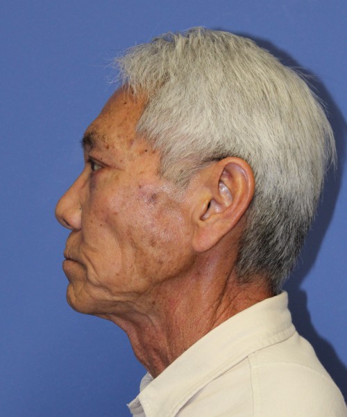 Blepharoplasty 2768 – Click HERE for more views after photo. Individual results may vary.