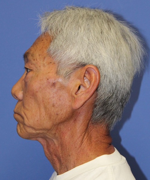 Blepharoplasty 2768 – Click HERE for more views before photo. Individual results may vary.