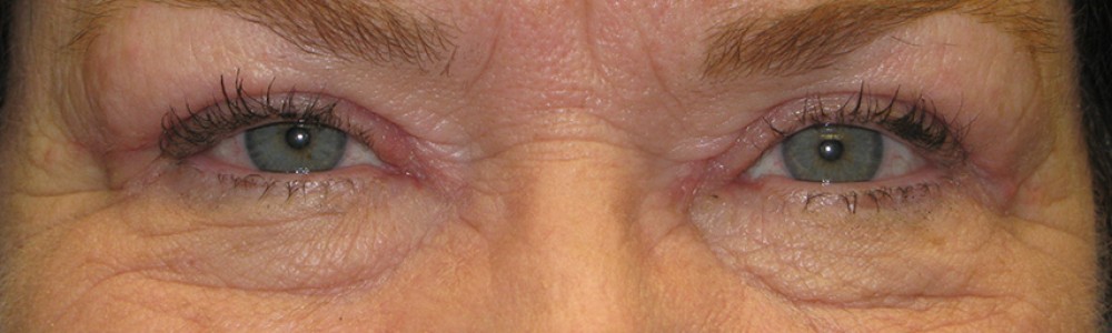 Blepharoplasty 2807 – Click HERE for more views after photo. Individual results may vary.