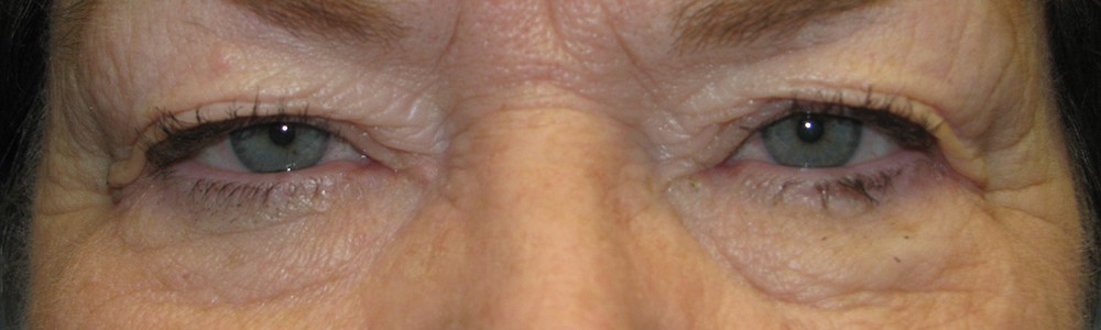 Blepharoplasty 2807 – Click HERE for more views before photo. Individual results may vary.