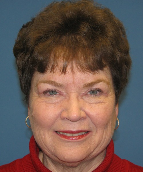 Blepharoplasty 2807 – Click HERE for more views after photo. Individual results may vary.