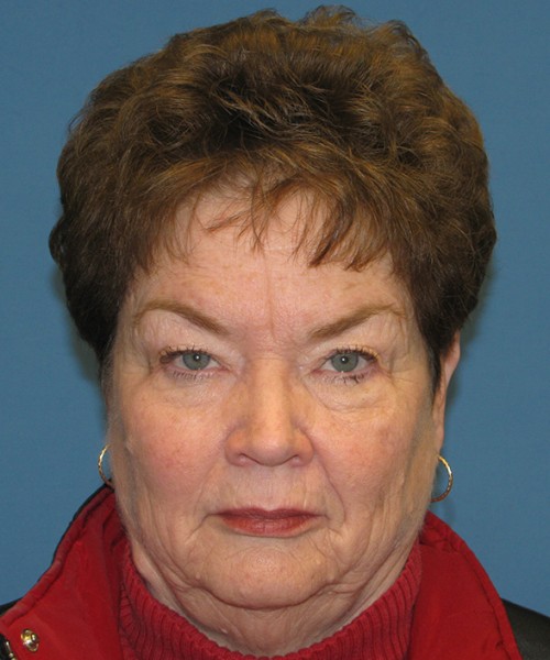 Blepharoplasty 2807 – Click HERE for more views before photo. Individual results may vary.