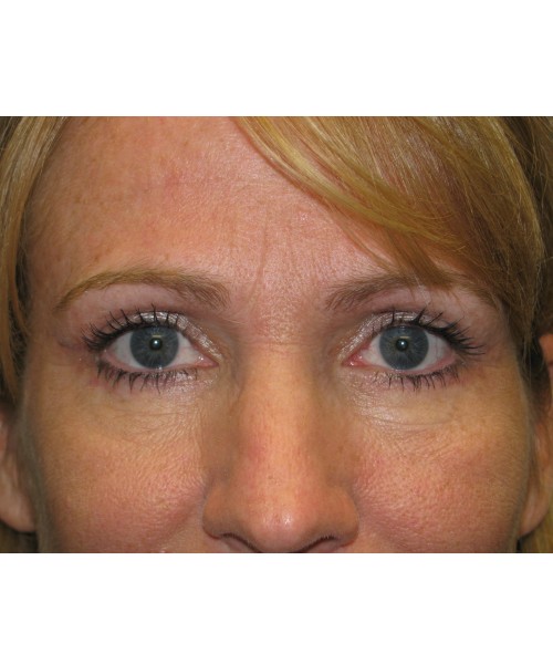 Blepharoplasty 2812 – Click HERE for more views after photo. Individual results may vary.