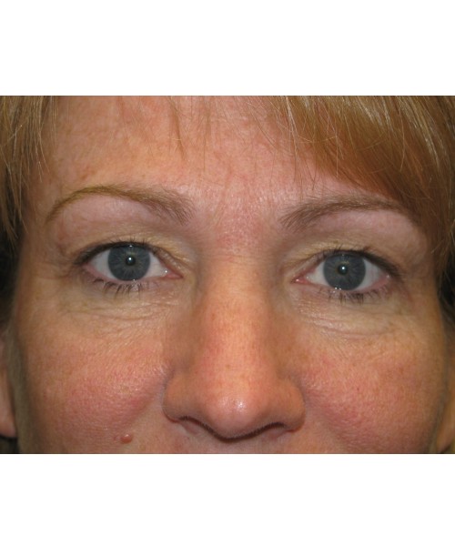 Blepharoplasty 2812 – Click HERE for more views before photo. Individual results may vary.