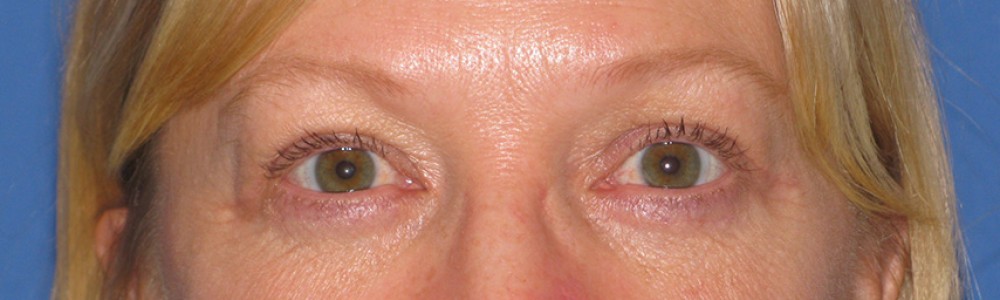 Blepharoplasty 2813 – Click HERE for more views after photo. Individual results may vary.