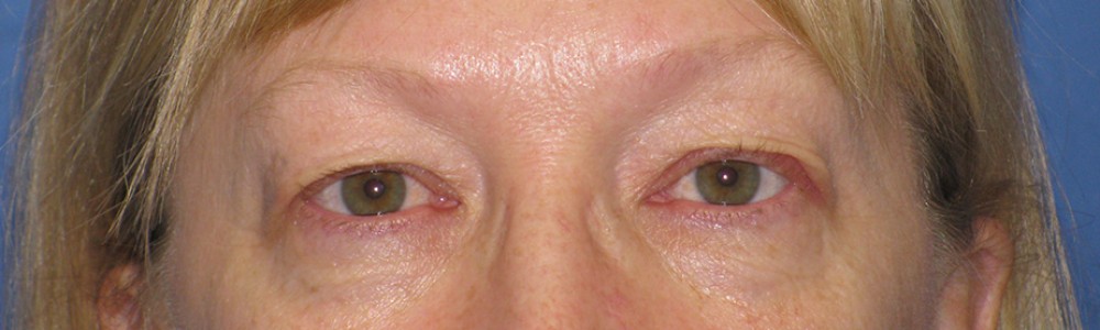Blepharoplasty 2813 – Click HERE for more views before photo. Individual results may vary.