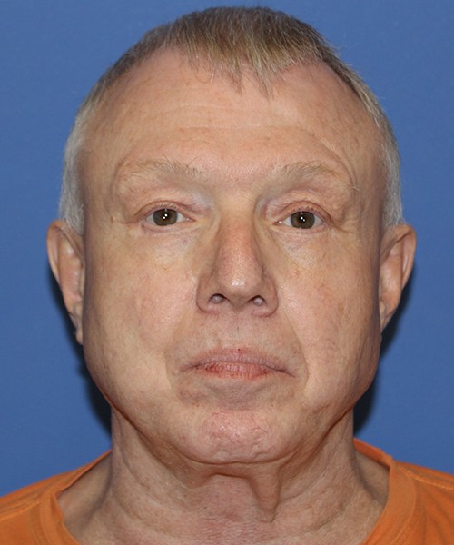 Blepharoplasty 2814 – Click HERE for more views after photo. Individual results may vary.