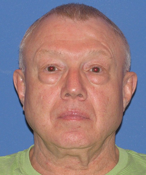 Blepharoplasty 2814 – Click HERE for more views before photo. Individual results may vary.