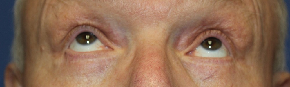 Blepharoplasty 2814 – Click HERE for more views after photo. Individual results may vary.