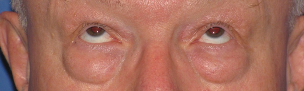 Blepharoplasty 2814 – Click HERE for more views before photo. Individual results may vary.