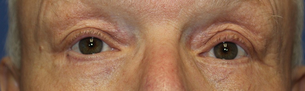 Blepharoplasty 2814 – Click HERE for more views after photo. Individual results may vary.