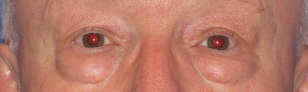 Blepharoplasty 2814 – Click HERE for more views before photo. Individual results may vary.