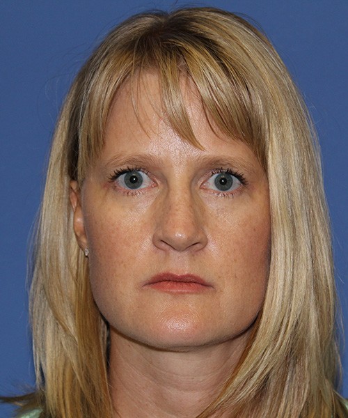 Blepharoplasty 2832 – Click HERE for more views after photo. Individual results may vary.