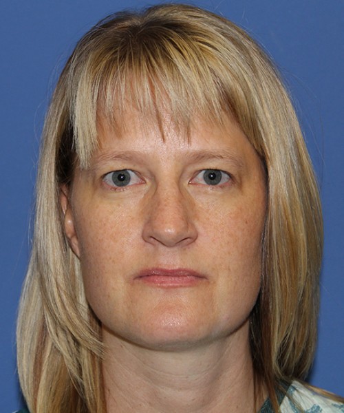 Blepharoplasty 2832 – Click HERE for more views before photo. Individual results may vary.