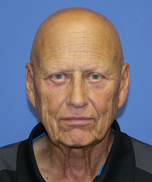 Blepharoplasty 2835 – Click HERE for more views after photo. Individual results may vary.