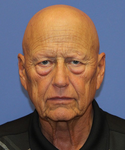 Blepharoplasty 2835 – Click HERE for more views before photo. Individual results may vary.