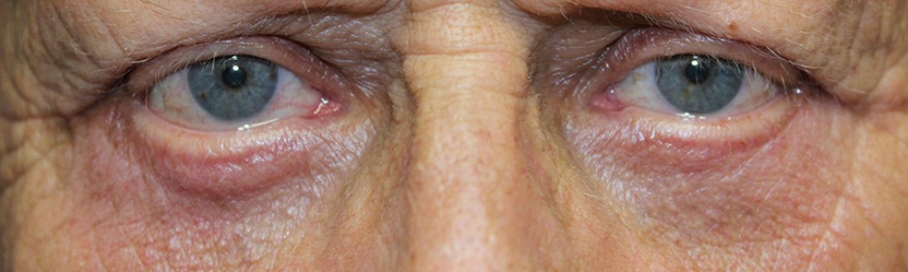 Blepharoplasty 2835 – Click HERE for more views after photo. Individual results may vary.