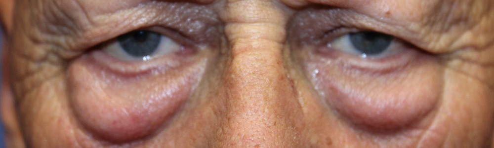 Blepharoplasty 2835 – Click HERE for more views before photo. Individual results may vary.