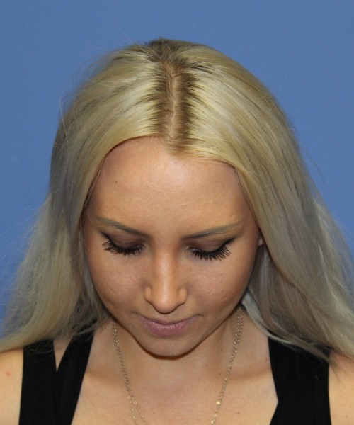 Rhinoplasty 0312 – Click HERE for more views after photo. Individual results may vary.