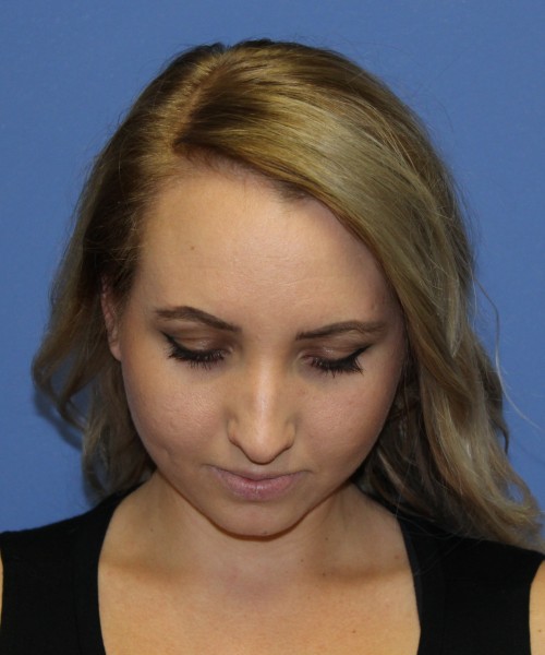 Rhinoplasty 0312 – Click HERE for more views before photo. Individual results may vary.