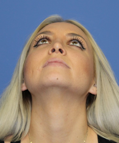 Rhinoplasty 0312 – Click HERE for more views after photo. Individual results may vary.