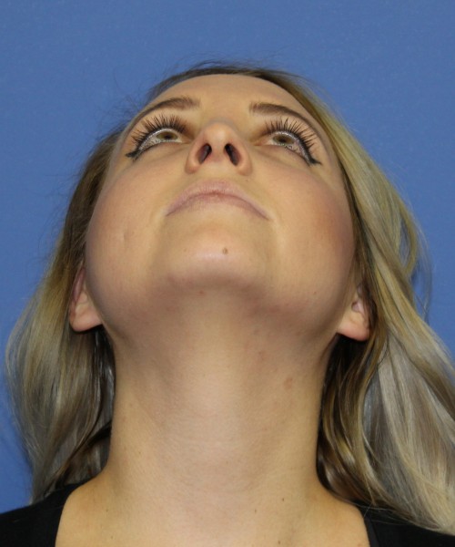 Rhinoplasty 0312 – Click HERE for more views before photo. Individual results may vary.