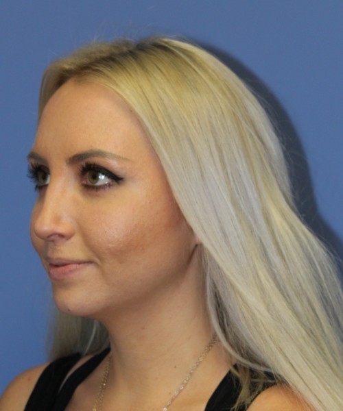 Rhinoplasty 0312 – Click HERE for more views after photo. Individual results may vary.