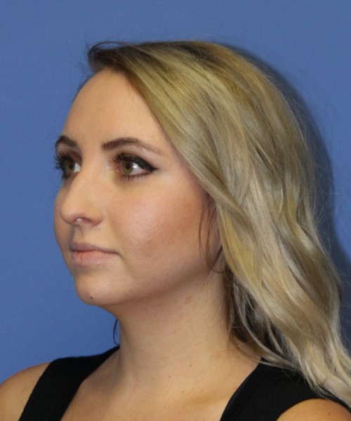 Rhinoplasty 0312 – Click HERE for more views before photo. Individual results may vary.