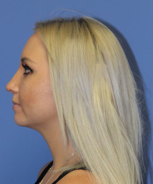 Rhinoplasty 0312 – Click HERE for more views after photo. Individual results may vary.