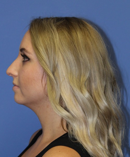 Rhinoplasty 0312 – Click HERE for more views before photo. Individual results may vary.