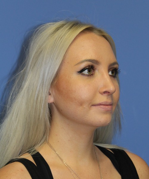 Rhinoplasty 0312 – Click HERE for more views after photo. Individual results may vary.