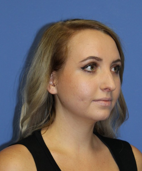 Rhinoplasty 0312 – Click HERE for more views before photo. Individual results may vary.