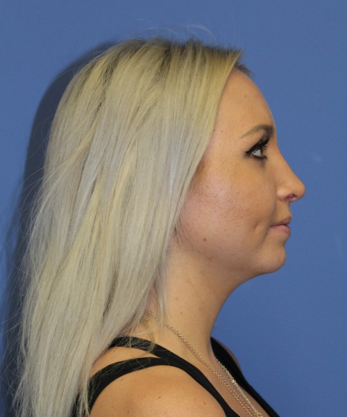 Rhinoplasty 0312 – Click HERE for more views after photo. Individual results may vary.