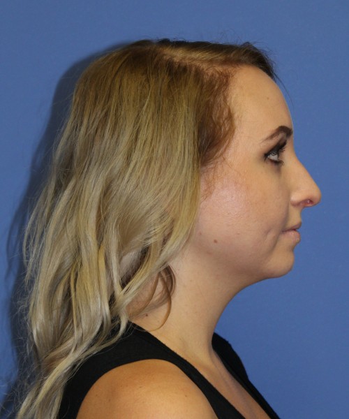 Rhinoplasty 0312 – Click HERE for more views before photo. Individual results may vary.