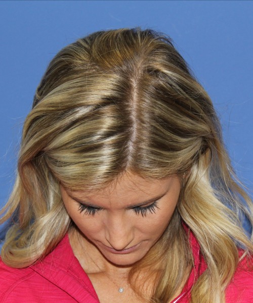 Rhinoplasty 0327 – Click HERE for more views after photo. Individual results may vary.